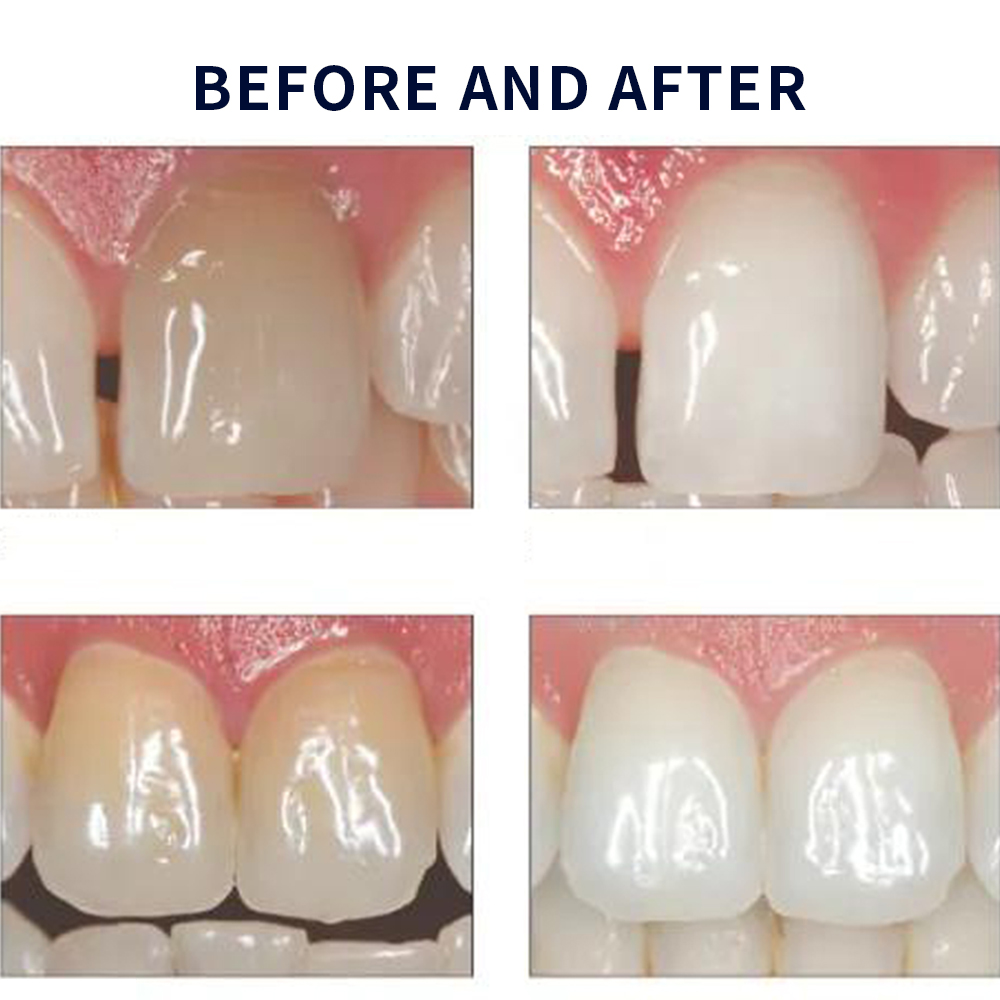 Opalescence Whitening 20% PF 2 - огляд і ціна Teeth Whitening Doctor
