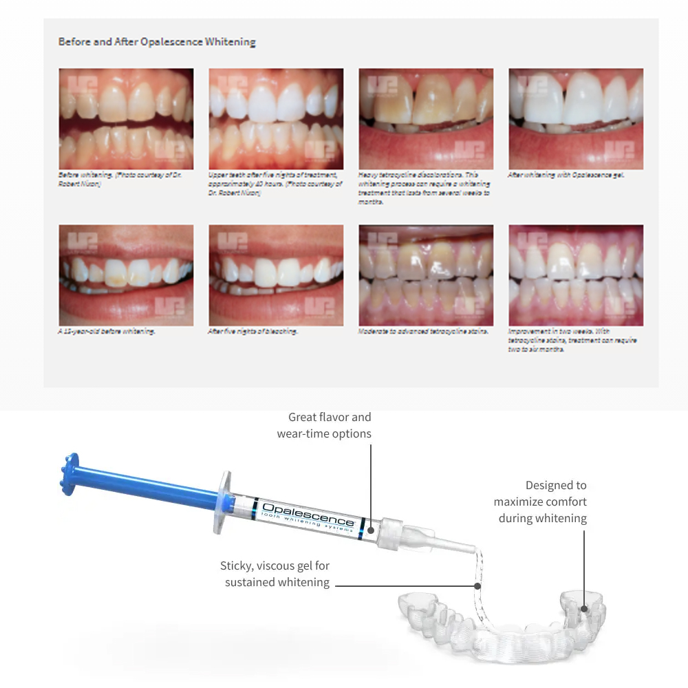 Opalescence Whitening 20% PF 2 - огляд і ціна Teeth Whitening Doctor